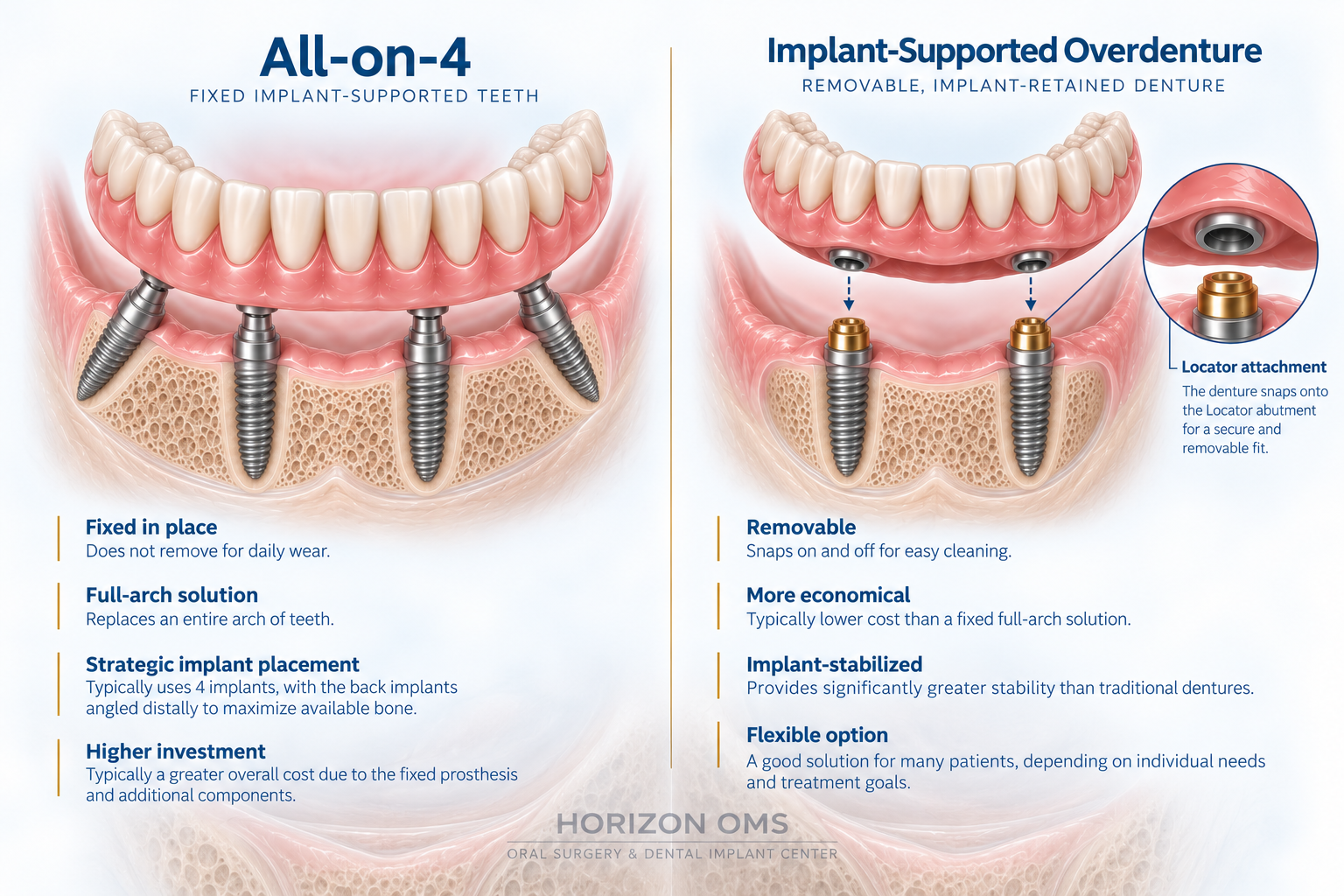 Side-by-side comparison of fixed All-on-4 full-arch teeth on four implants and a removable implant-supported overdenture on two locator attachments