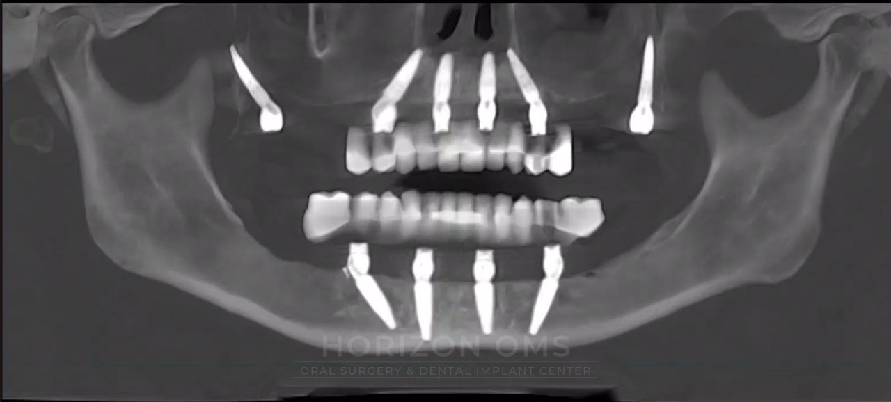 CBCT panoramic X-ray showing bilateral pterygoid implants supporting full-arch All-on-X restoration in both jaws — case treated by Dr. Ali Al-Qudsi at Horizon OMS of Chicago