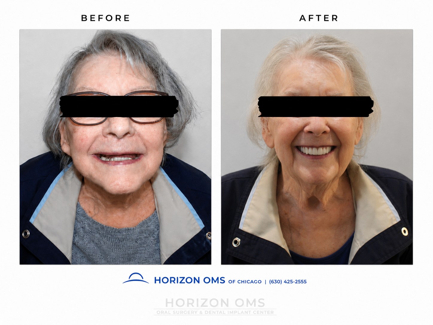 Before and after clinical portrait showing full-arch dental implant rehabilitation with improved smile support, tooth display, and fixed All-on-X implant teeth at Horizon OMS of Chicago in Lombard Illinois.