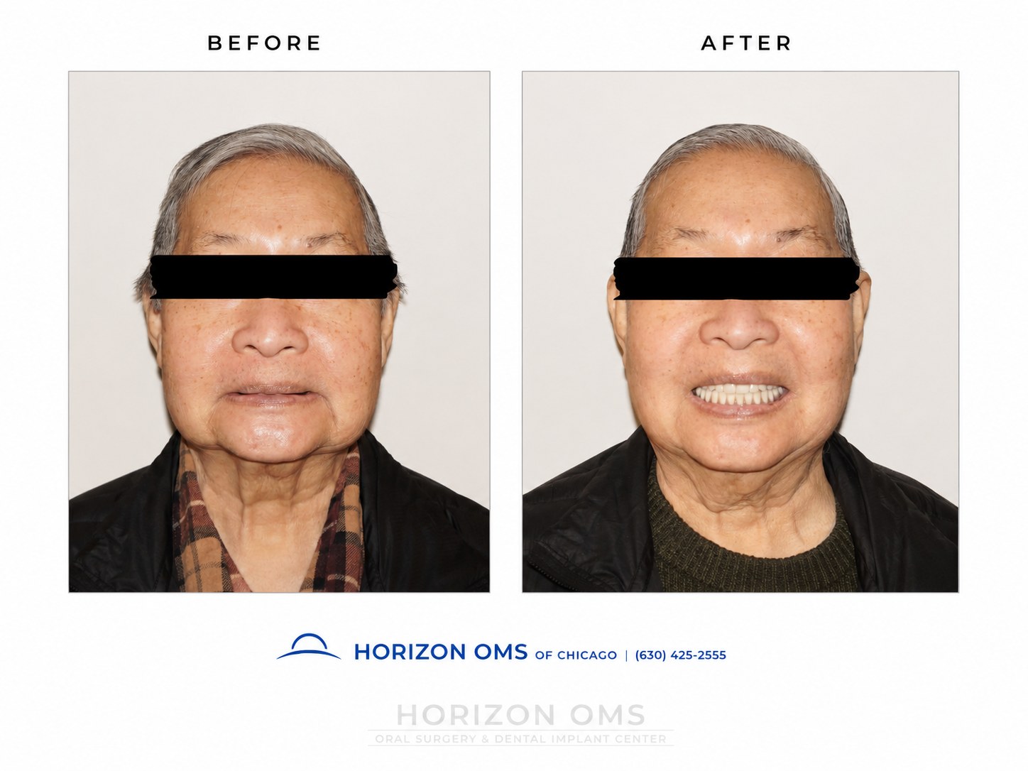 Before and after full-arch implant smile transformation showing replacement of failing teeth with fixed implant-supported teeth for improved facial support and dental function in Lombard Illinois.