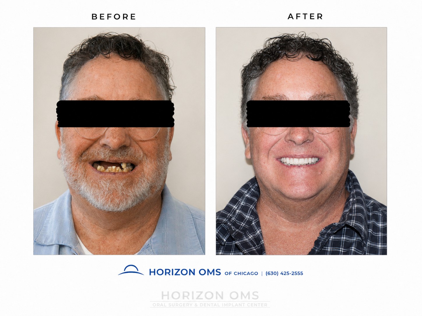 Clinical before and after All-on-X dental implant case showing severe tooth loss restored with a fixed full-arch implant bridge and improved smile aesthetics at Horizon OMS of Chicago.