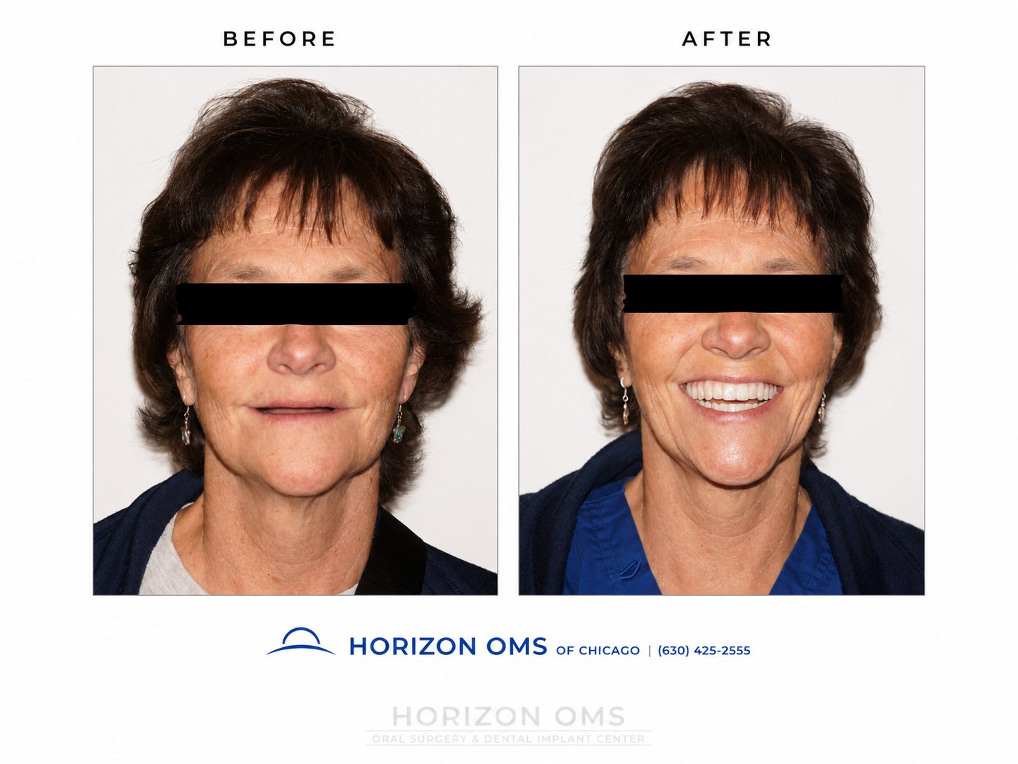 Before and after portrait of full-arch dental implant treatment showing restored tooth display, smile symmetry, and fixed implant-supported teeth after oral surgery and restorative coordination.