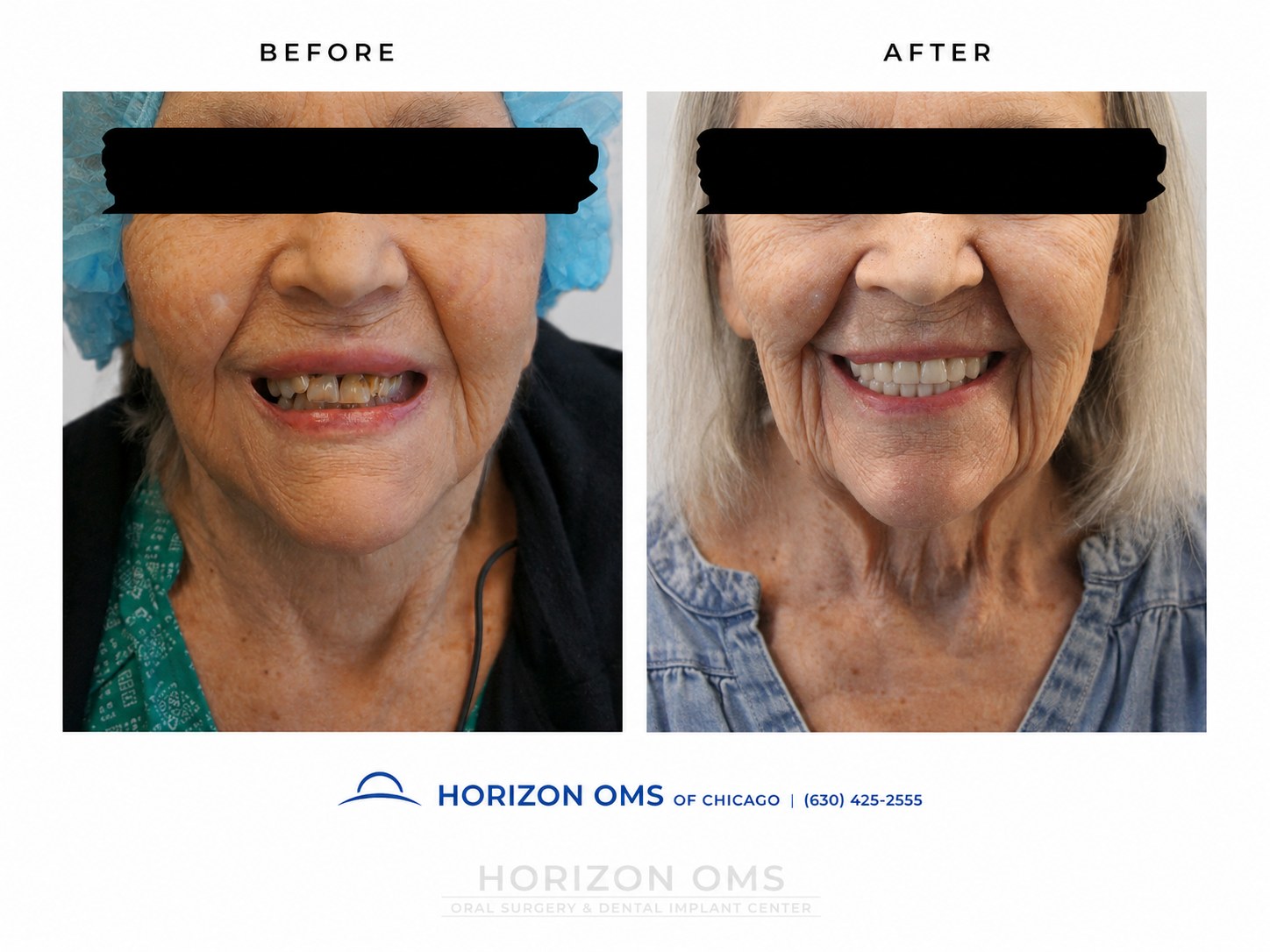 Close-up before and after smile gallery image showing All-on-X full-arch implant rehabilitation with improved tooth position, bite support, and natural-looking fixed teeth.