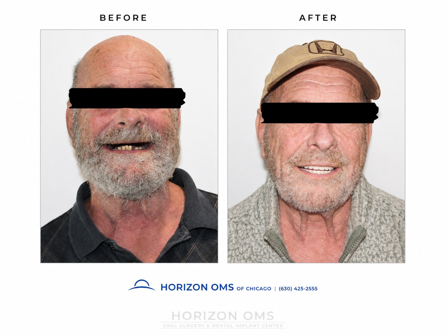 Before and after clinical portrait showing advanced full-mouth implant reconstruction with improved smile line and fixed full-arch implant teeth planned by an oral surgeon in Lombard Illinois.