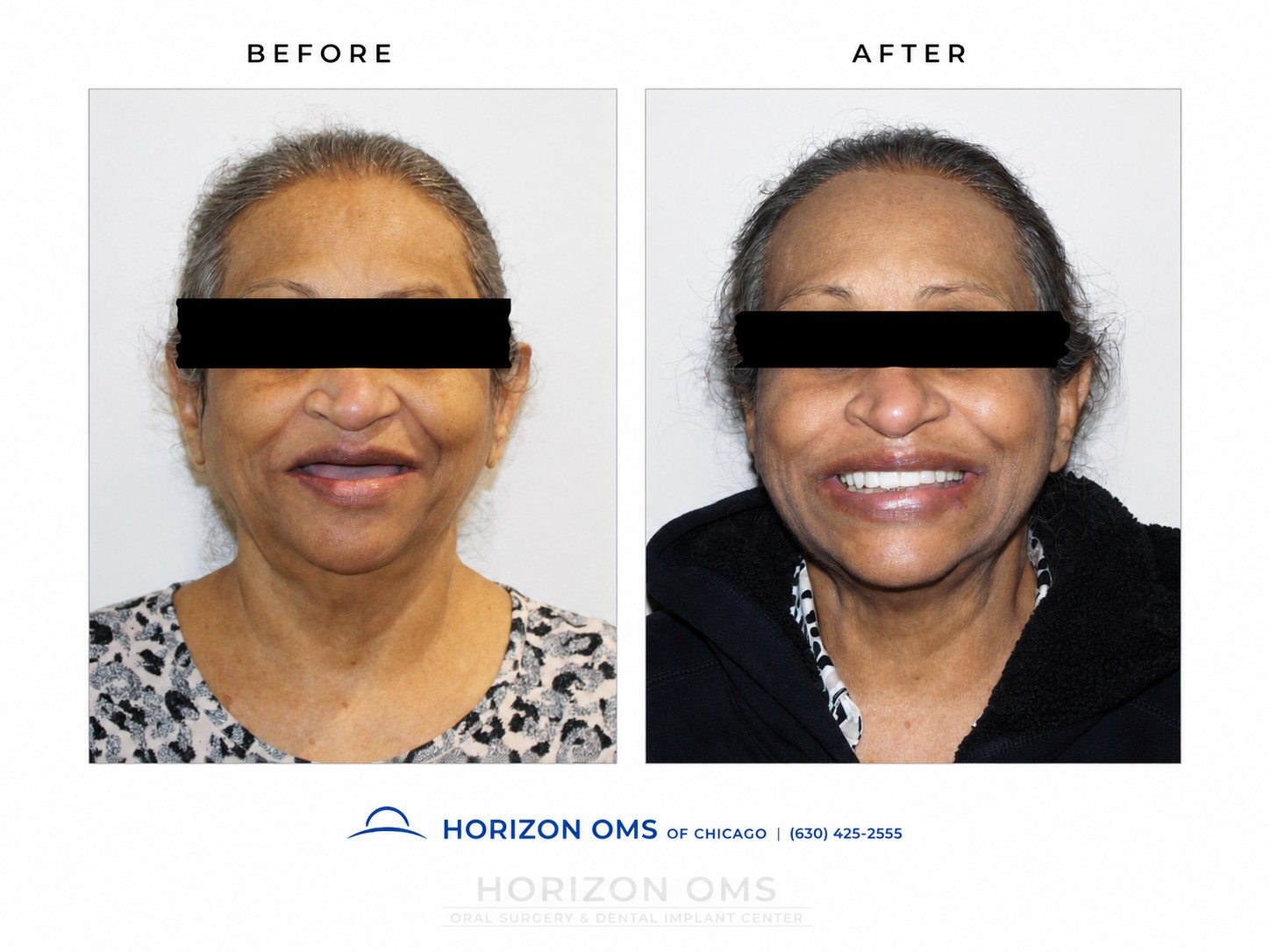 Before and after All-on-X implant rehabilitation portrait showing replacement of missing or failing teeth with fixed full-arch implant-supported teeth and improved facial confidence.