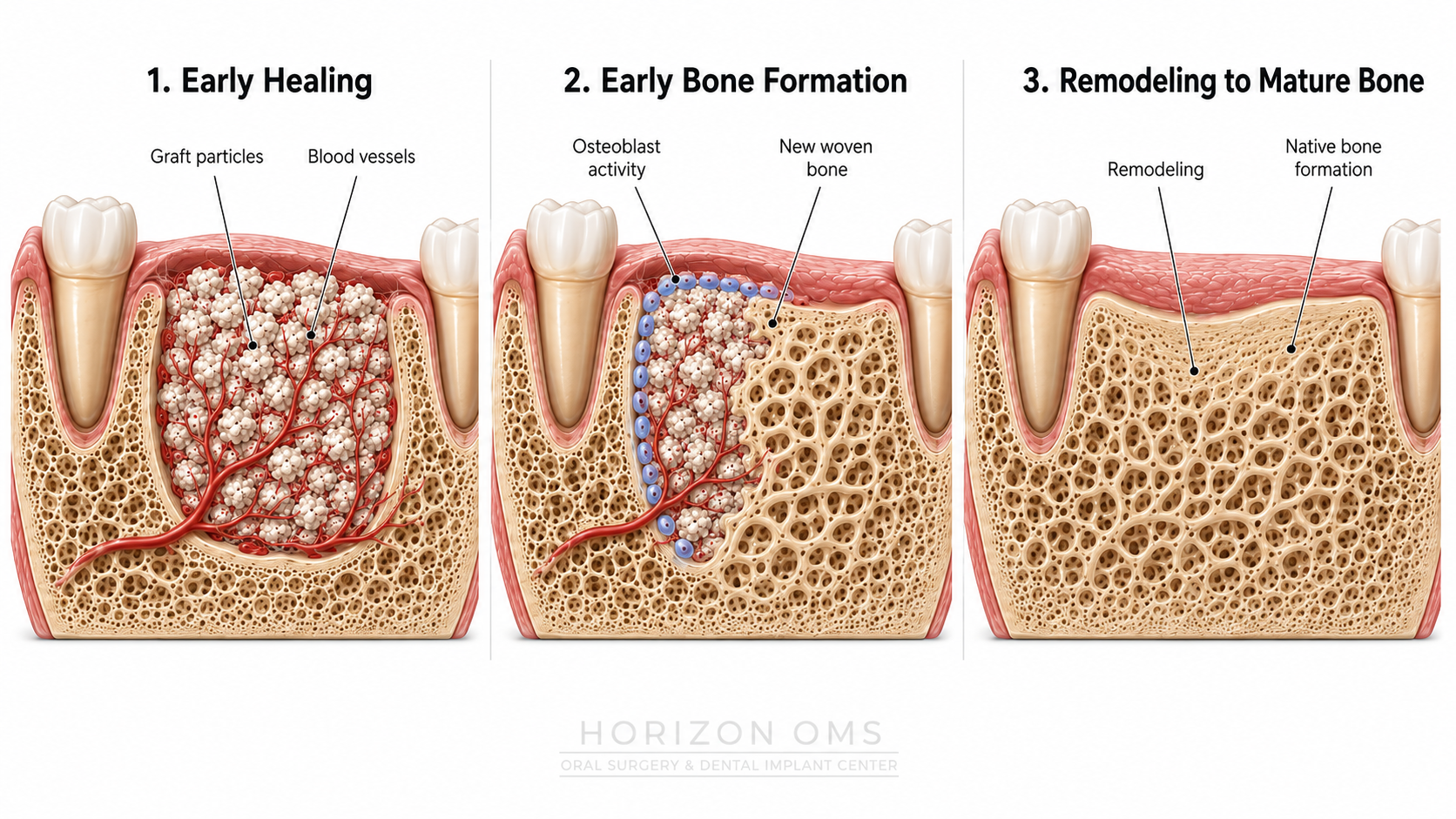 Three-panel medical illustration showing bone graft consolidation from early healing to new woven bone and mature native bone formation