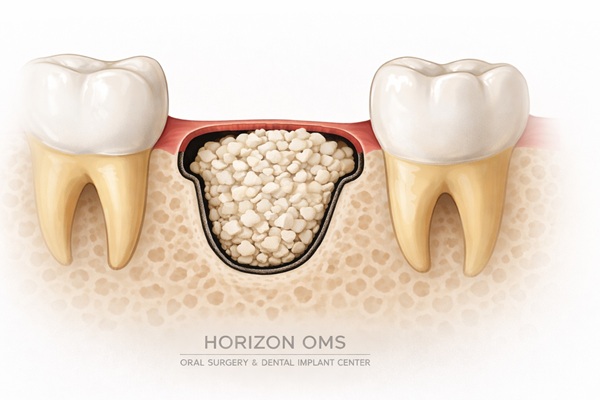 Bone grafting procedure for dental implants DuPage County IL