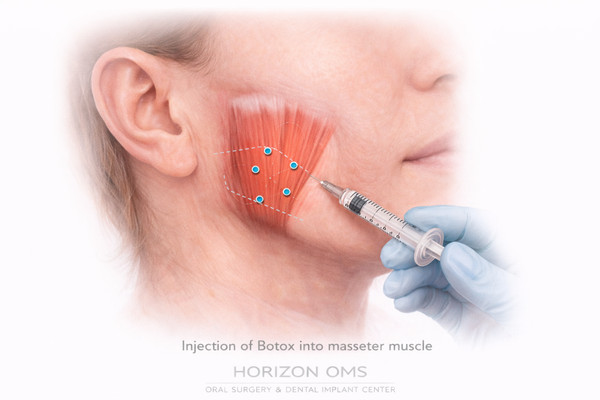 Botox treatment for TMJ pain and masseter muscle tension relief Lombard IL