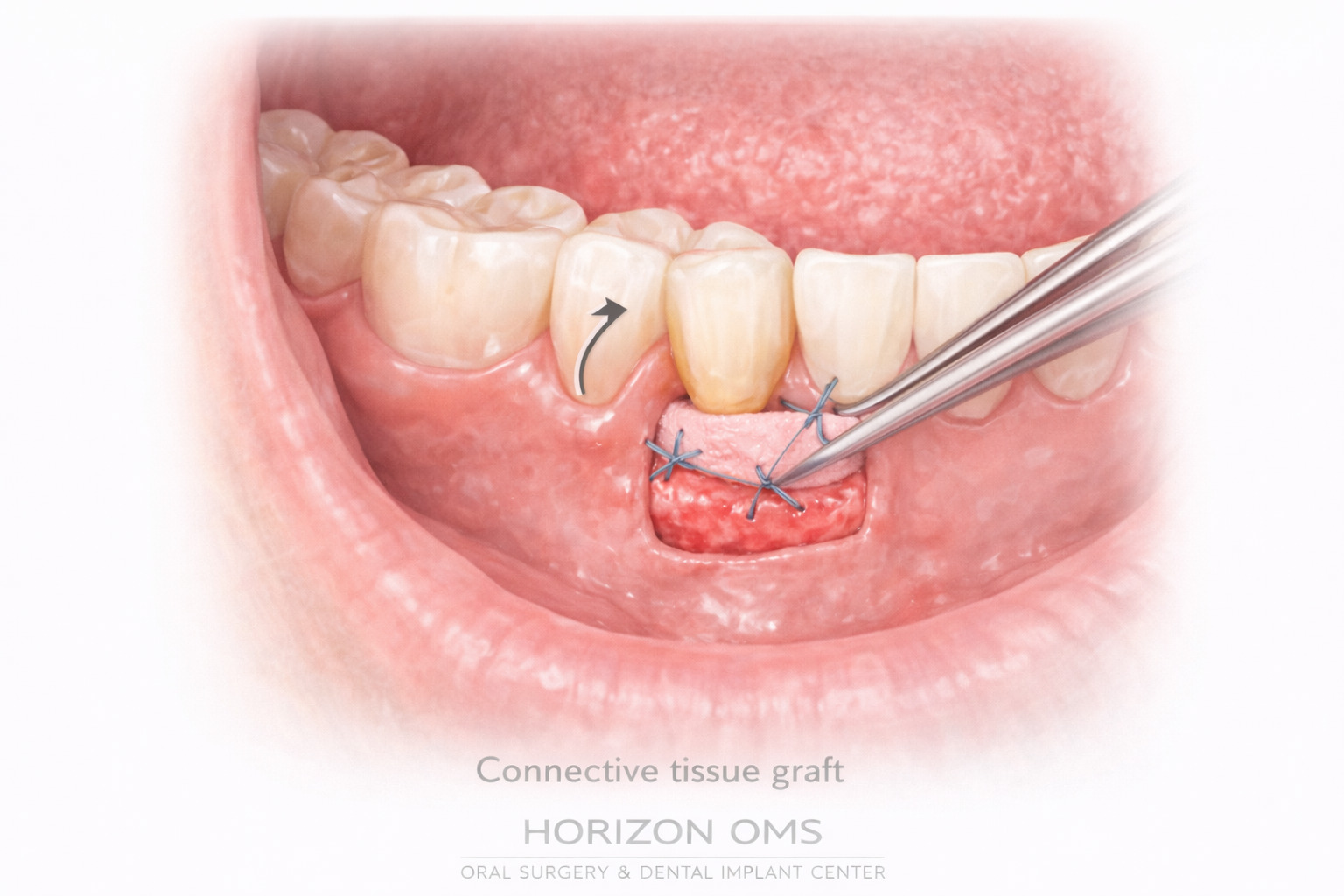 Soft tissue gum grafting procedure for gum recession treatment Lombard IL