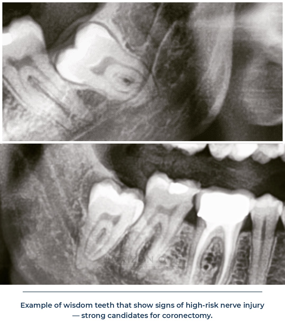 Panoramic X-ray example of wisdom teeth showing signs of high-risk nerve proximity, strong candidates for coronectomy