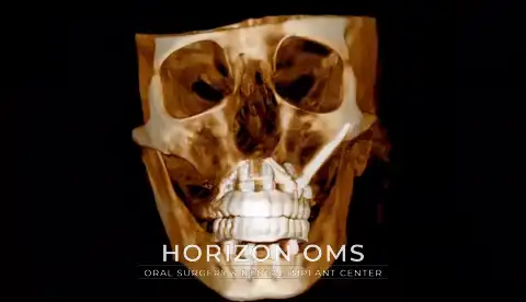 Animated 3D CBCT reconstruction showing full-arch implant restoration of both jaws with left-sided zygomatic and pterygoid implants — case treated by Dr. Ali Al-Qudsi at Horizon OMS of Chicago