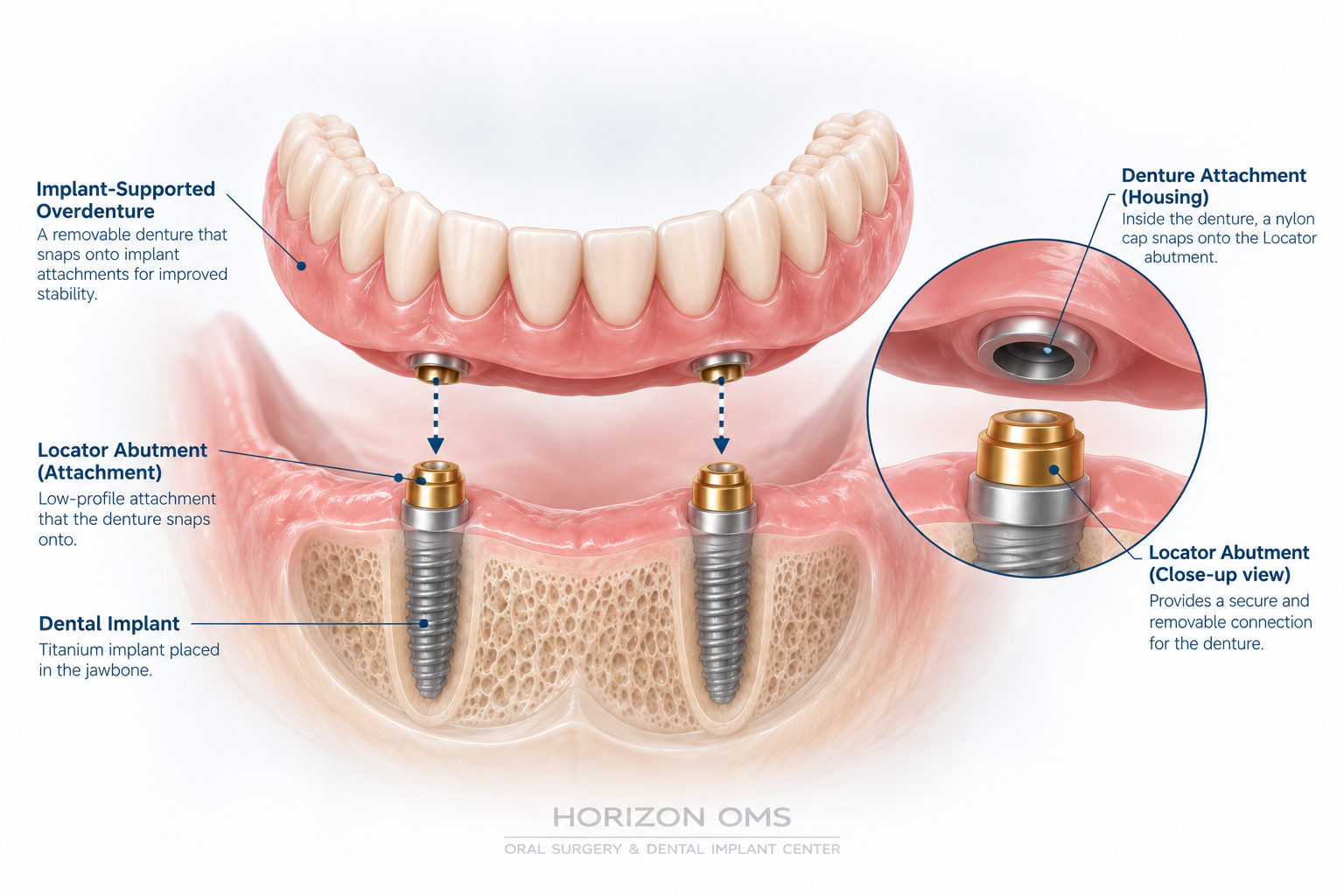 Labeled implant-supported overdenture components showing the removable denture, nylon attachment housing, locator abutment, and titanium dental implant in the jawbone