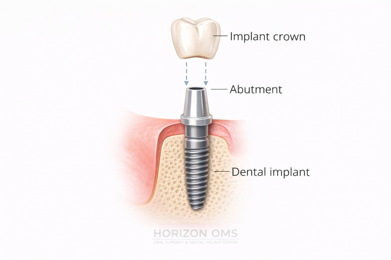 Dental implant surgery placement Lombard Illinois oral surgeon