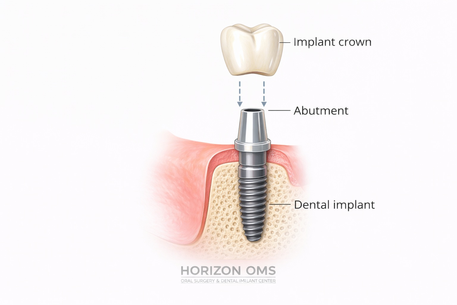 Dental implant placement procedure by board-certified oral surgeon in Lombard IL