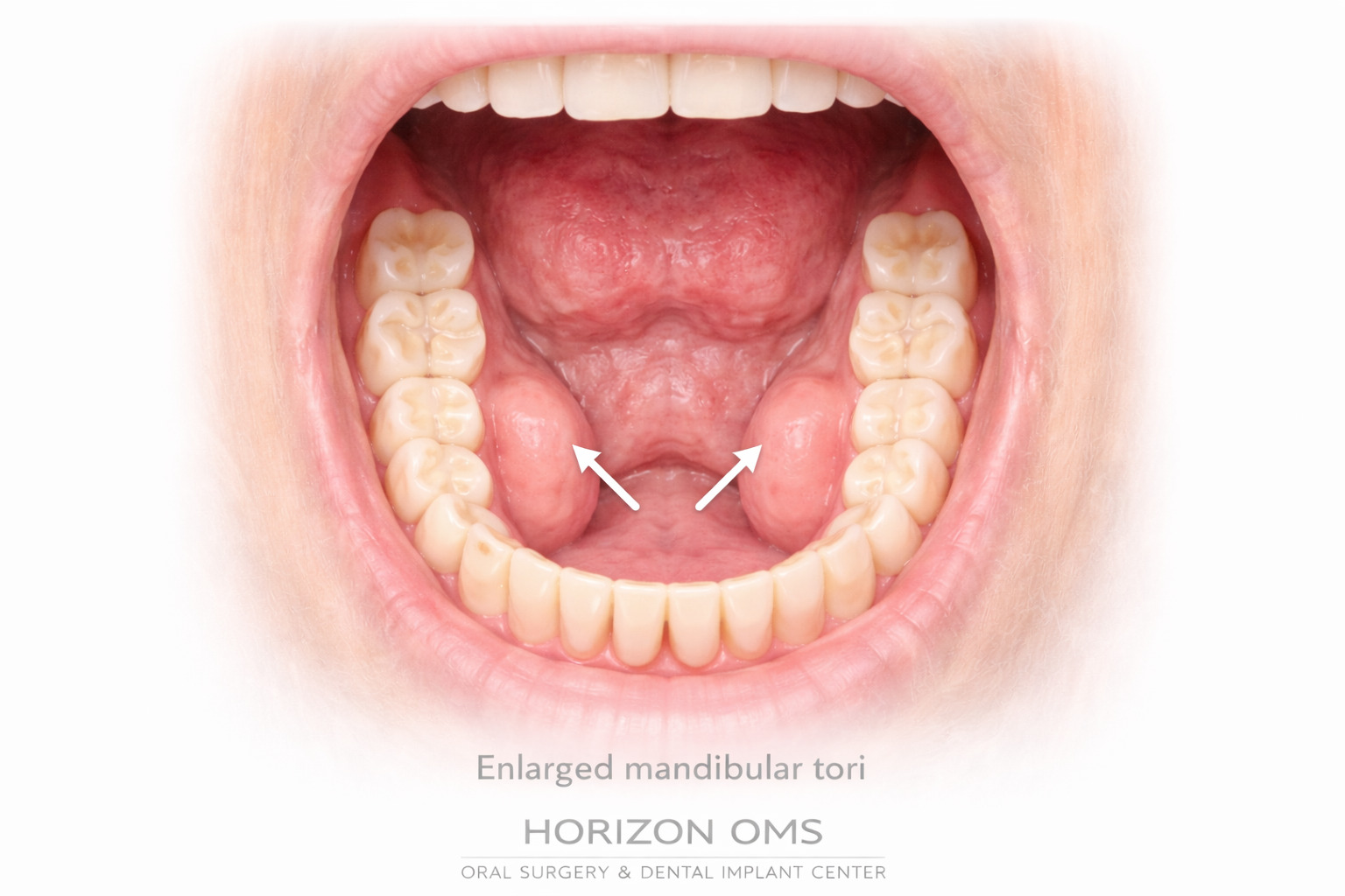 Mandibular tori removal illustration showing lower jaw bony growth removal