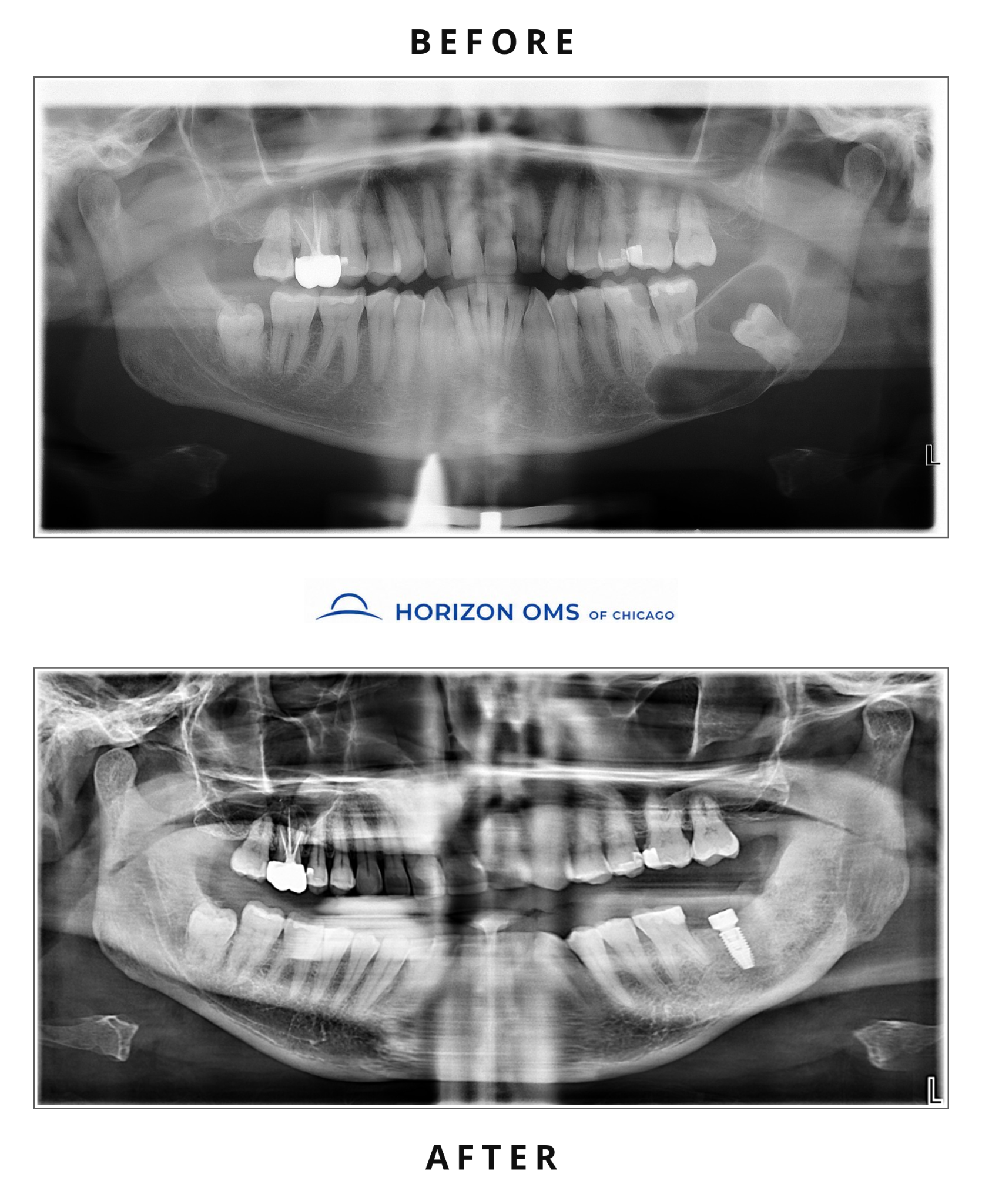 Before and after panoramic X-rays showing staged management of a very large left mandibular lesion with decompression, complete removal, bone grafting, and later implant restoration — case treated by Dr. Ali Al-Qudsi at Horizon OMS of Chicago