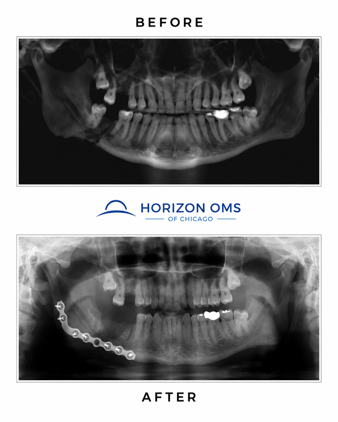 Before and after panoramic X-rays showing management of osteomyelitis with a pathological mandibular fracture using surgical debridement and reconstruction plate fixation — case treated by Dr. Ali Al-Qudsi at Horizon OMS of Chicago