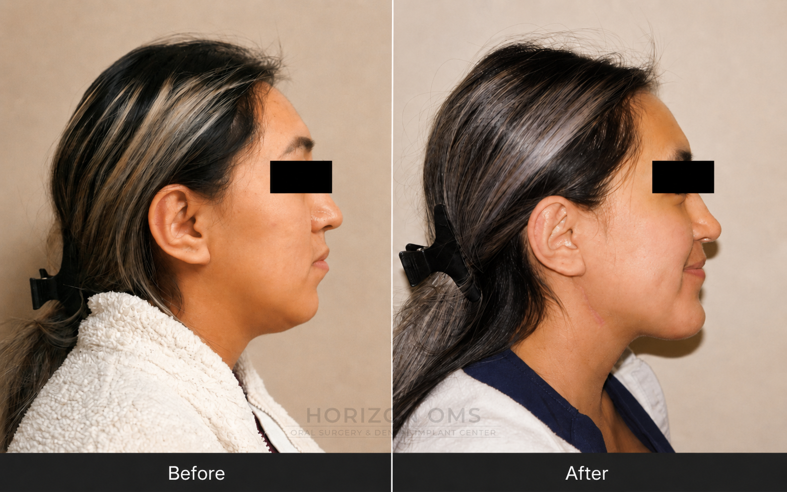 Before and after profile photographs showing bilateral TMJ replacement with Le Fort I advancement and genioplasty for facial balance and airway improvement — case treated by Dr. Ali Al-Qudsi at Horizon OMS of Chicago