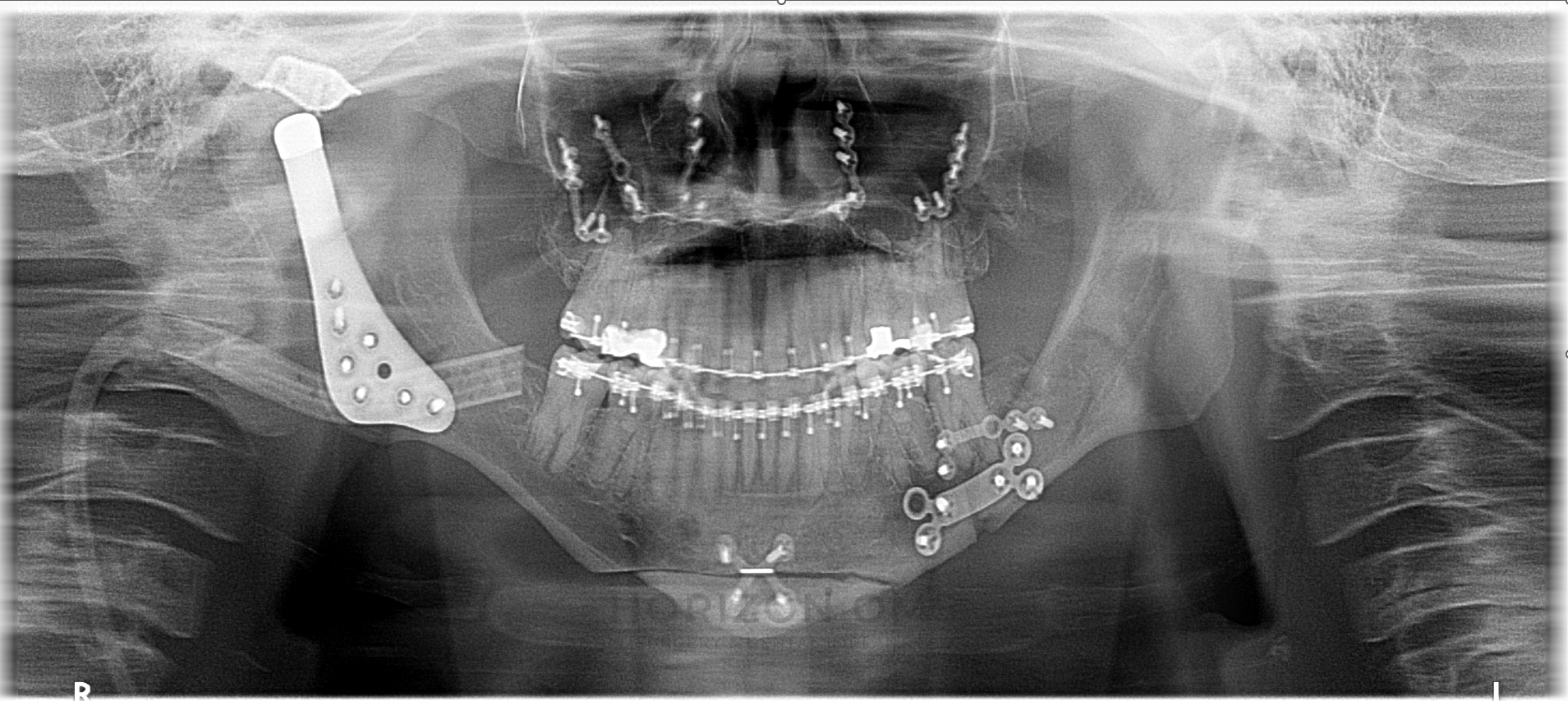 Panoramic X-ray showing combined corrective jaw surgery and right custom total joint replacement — case treated by Dr. Ali Al-Qudsi at Horizon OMS of Chicago