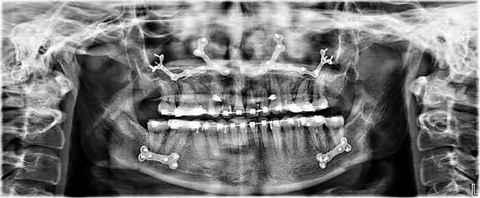Panoramic X-ray showing double-jaw corrective surgery with maxillary advancement, mandibular setback, and temporary anchorage devices in the maxilla — case treated by Dr. Ali Al-Qudsi at Horizon OMS of Chicago