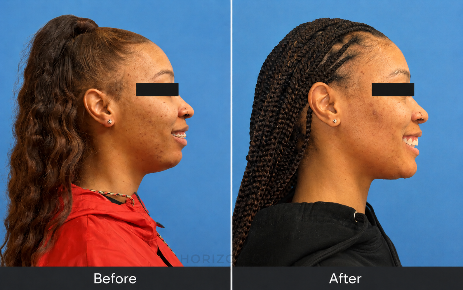 Before and after profile photographs showing triple jaw surgery with LeFort I advancement and rotation, bilateral sagittal split osteotomies, and genioplasty — case treated by Dr. Ali Al-Qudsi at Horizon OMS of Chicago