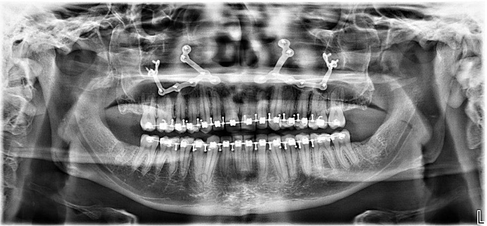 Panoramic X-ray showing single-jaw Le Fort I maxillary advancement coordinated with traditional orthodontic braces — case treated by Dr. Ali Al-Qudsi at Horizon OMS of Chicago