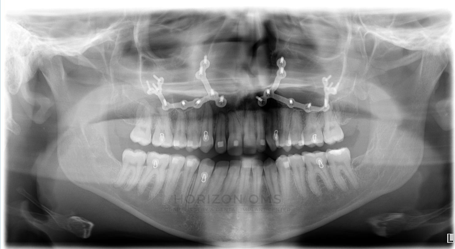Panoramic X-ray showing single-jaw Le Fort I maxillary advancement with Invisalign clear-aligner orthodontic treatment — case treated by Dr. Ali Al-Qudsi at Horizon OMS of Chicago