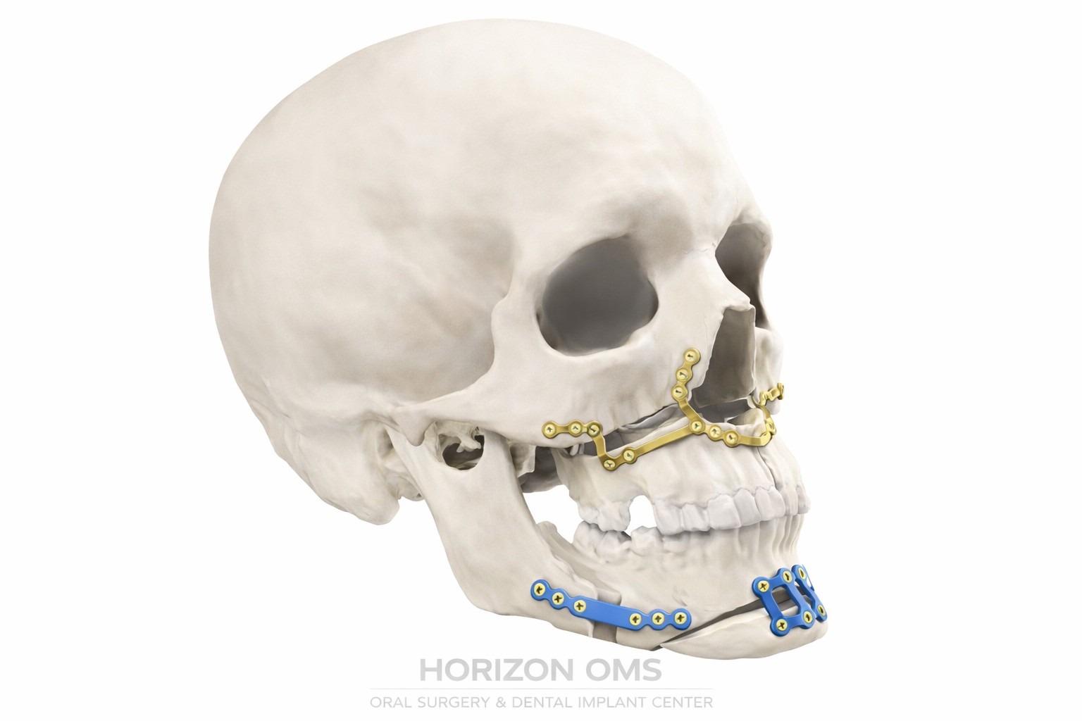 Corrective jaw surgery orthognathic procedure planning and 3D imaging