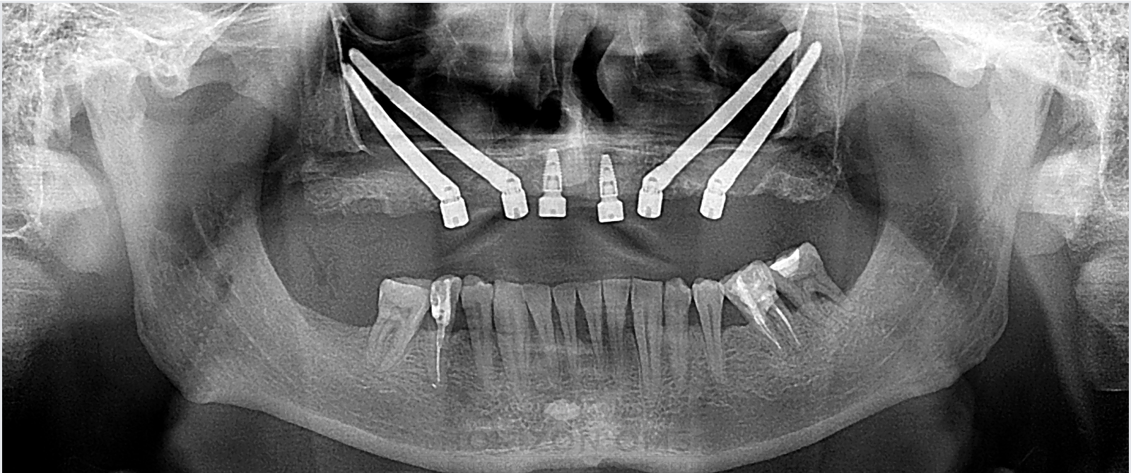 Panoramic X-ray showing placement of 4 zygomatic implants in a severely resorbed maxilla with two additional implants for increased stability — case treated by Dr. Ali Al-Qudsi at Horizon OMS of Chicago