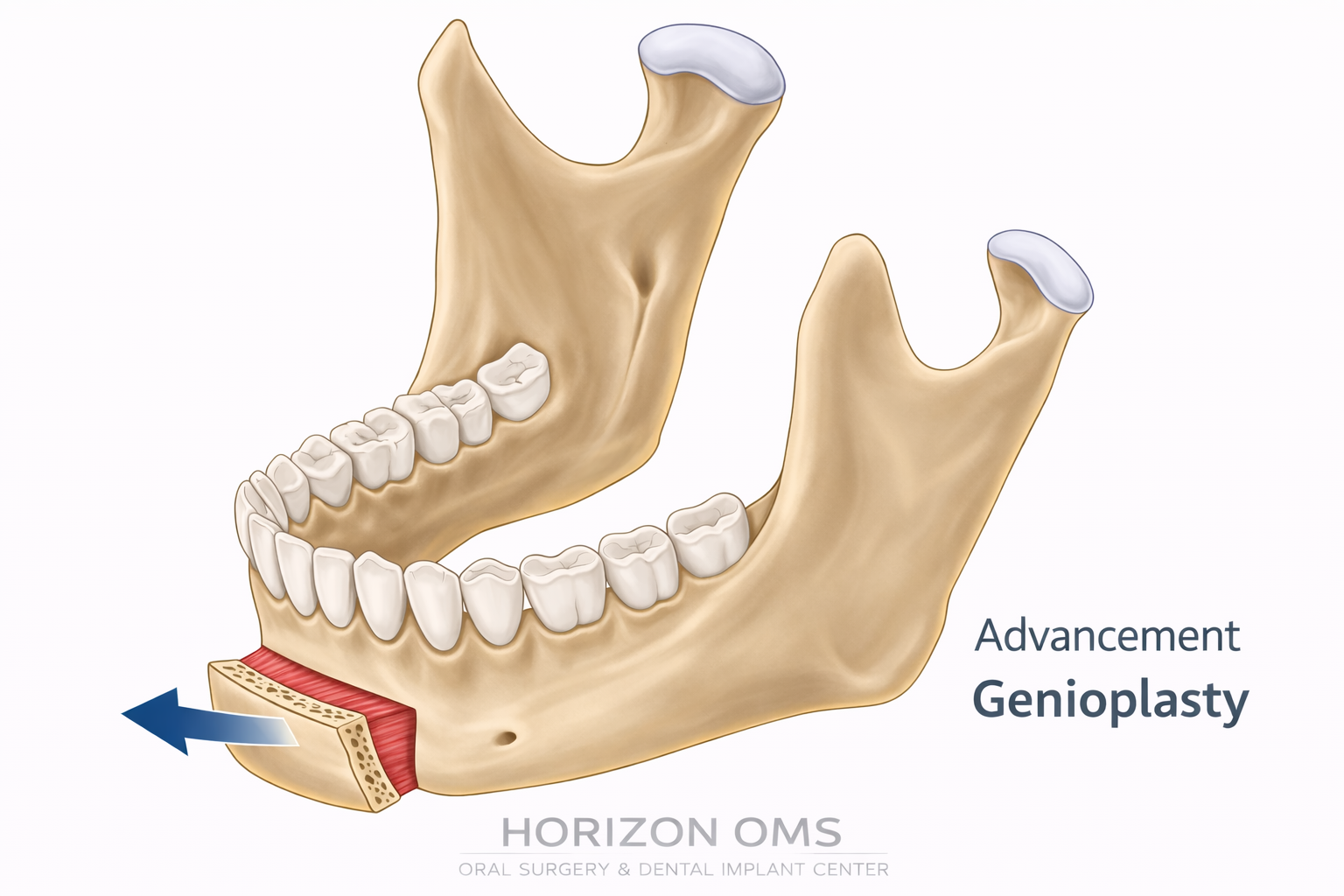 Illustration of genioplasty advancement showing chin advancement and support of tongue muscle attachment