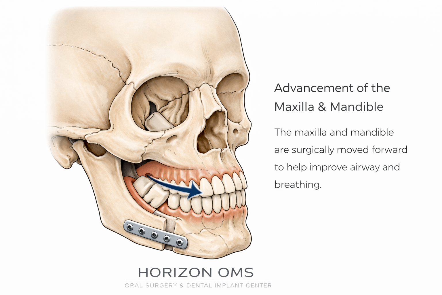 Illustration of maxillomandibular advancement showing upper and lower jaw advancement for airway-focused jaw surgery