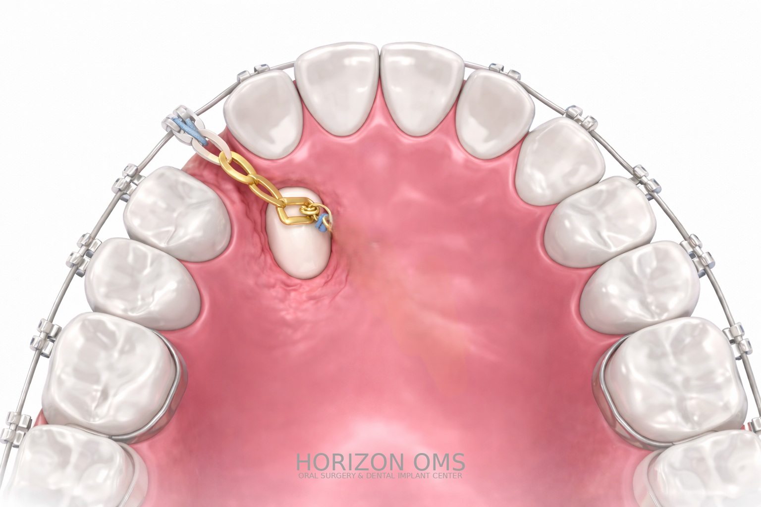 Surgical orthodontic expose and bond procedure for impacted teeth Lombard IL