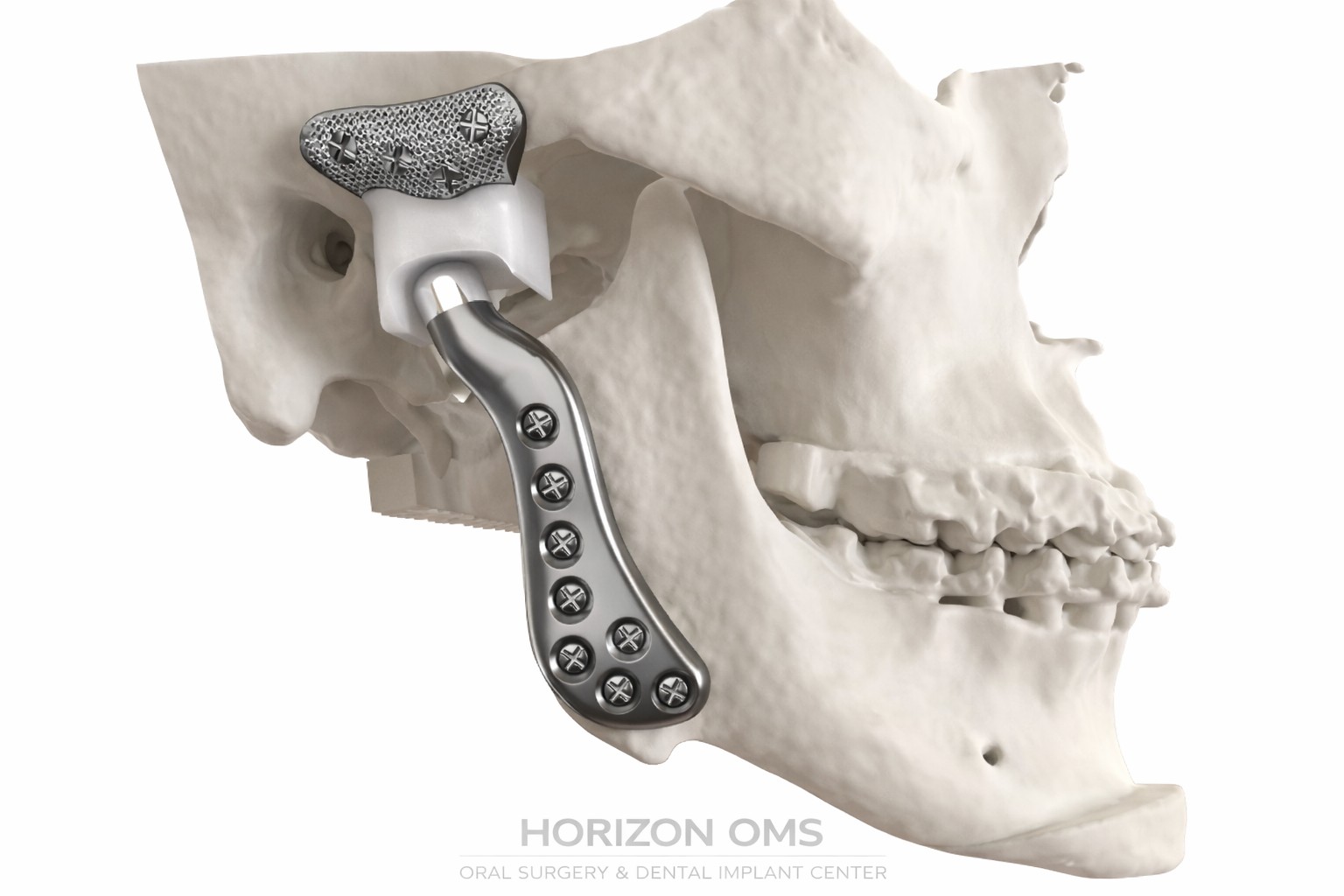 TMJ treatment and jaw joint surgery illustration by board-certified oral surgeon in Lombard IL