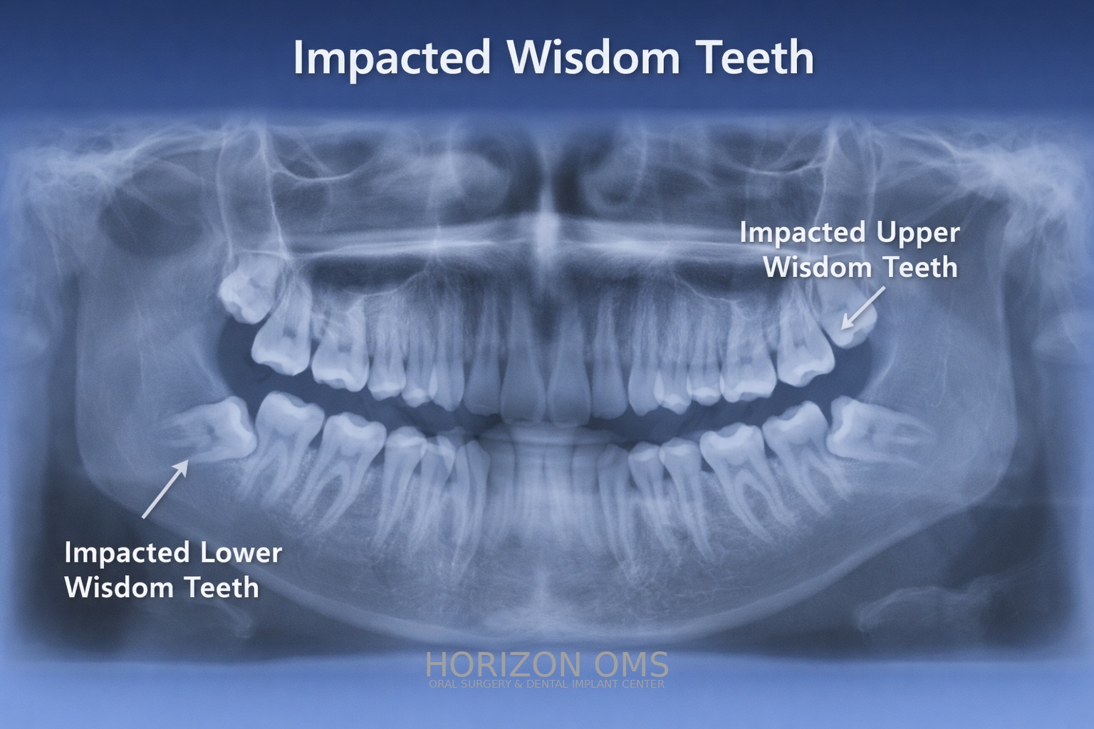 Wisdom teeth extraction surgery room at Horizon OMS Lombard Illinois