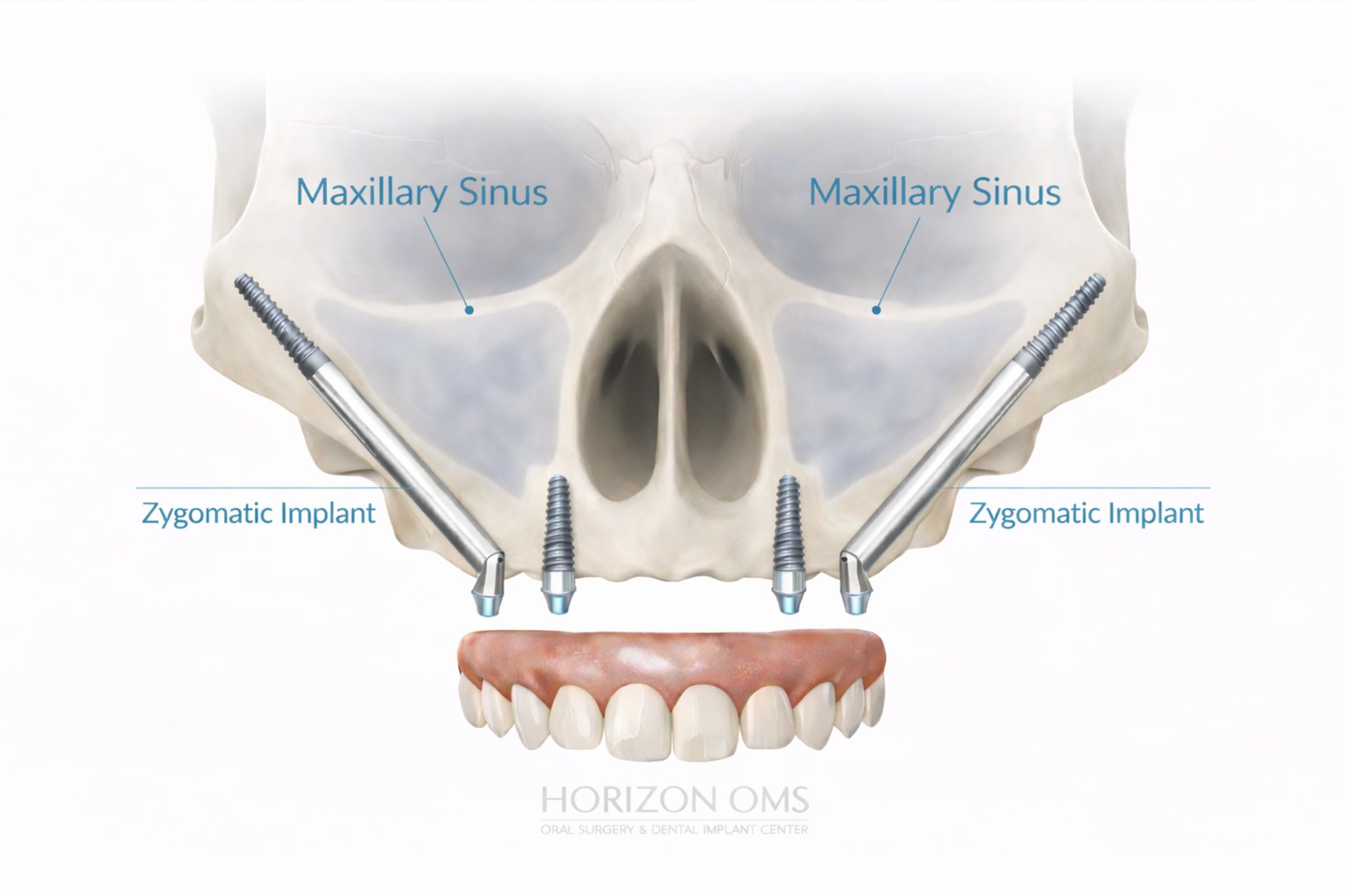 Advanced Implant Solutions in Lombard, IL | Horizon OMS of Chicago